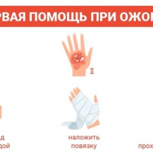 Как помочь человеку с термическими ожогами?